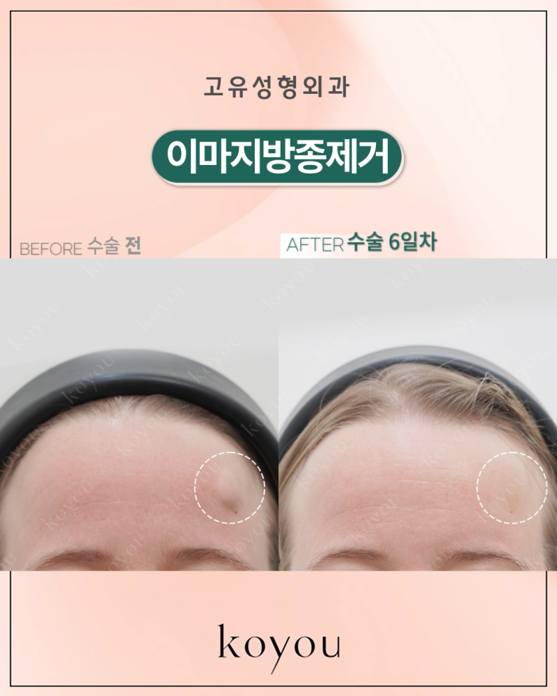 이마에 혹이 생겼다면? 이마 지방종·골종·표피낭종의 원인과 진단, 치료 방법
