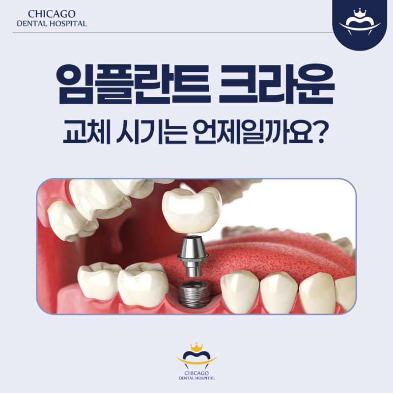 부개동치과, 임플란트 크라운 교체 시기는 언제일까요?