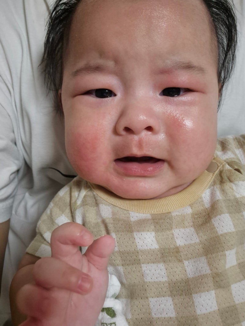 아기 동전습진, 갑자기 생긴 동그란 피부 발진 원인부터 관리방법까지