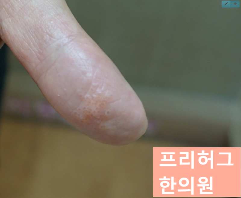 울산피부한의원 환자분의 질문 1 : 한포진과 손발 습진은 어떻게 다른가요?