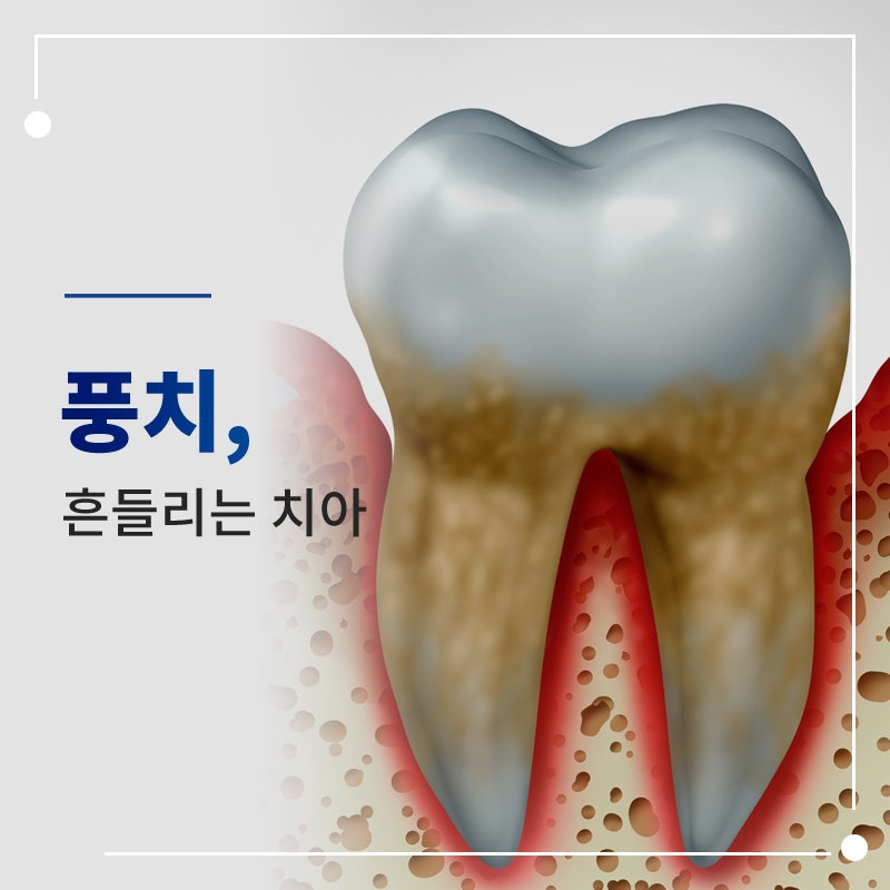 풍치 치료, 흔들리는 치아도 살릴 수 있을까요?