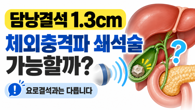 건강검진에서 담낭결석 1.3cm 발견, 체외충격파쇄석술로 깨면 될까?