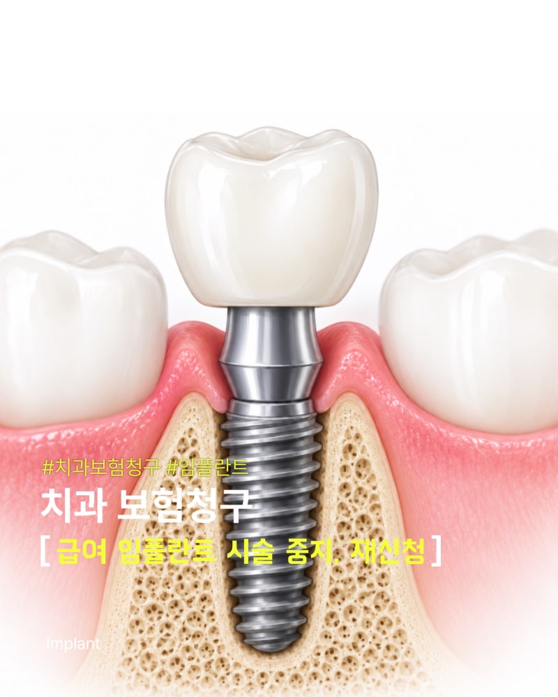 치과 보험청구 ㅣ 보험임플란트 2단계 중단 신청 방법 및 재식립 청구
