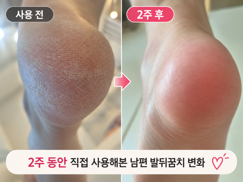 (내돈내산) 유리아크림 발뒤꿈치 각질 개선후기｜신랑에게 2주 사용해본 변화