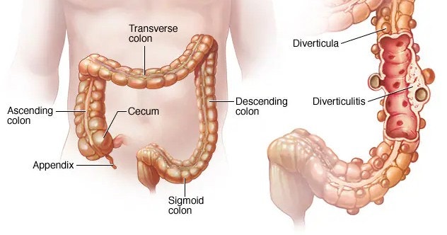 게실염 Diverticulitis 의료진 병원 진료·연구자 디렉토리 2026
