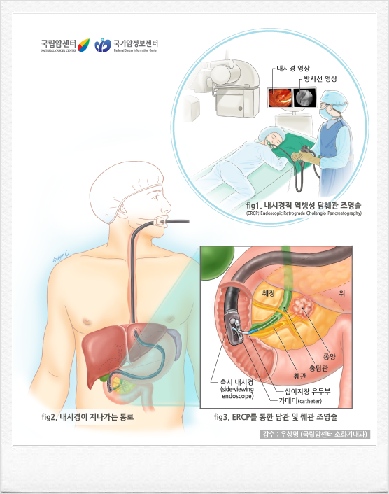 췌장암 진단을 받았다면, 무엇부터 알아봐야 할까요?