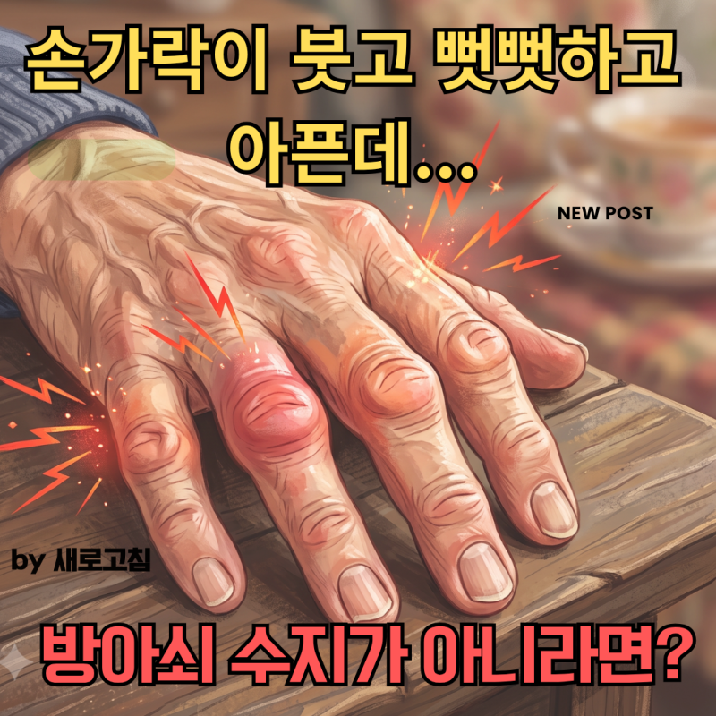 손가락이 붓고 뻣뻣하고 아픈데 방아쇠수지가 아니라면? 손목터널증후군, 드퀘르벵 건초염, ....