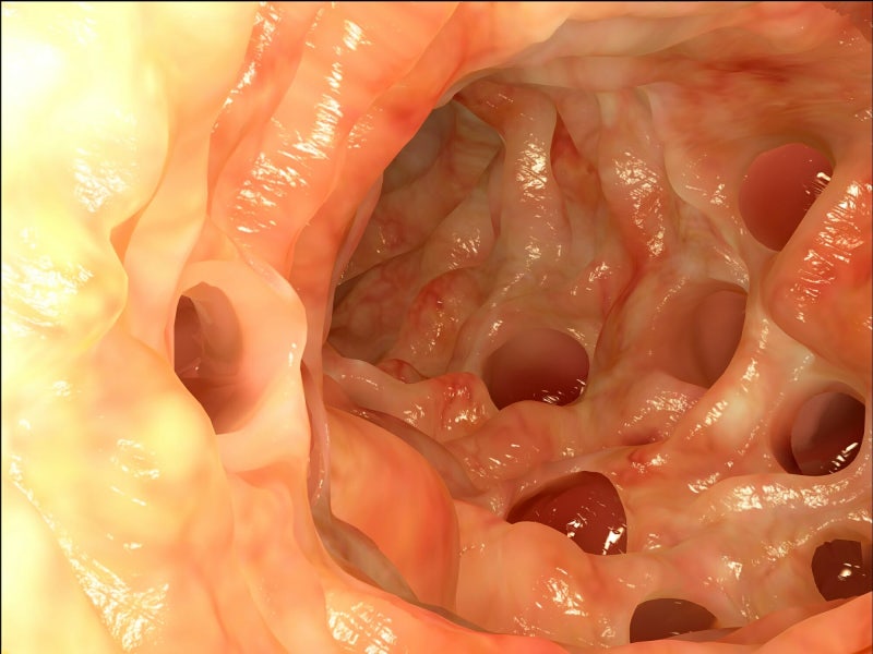 게실염 diverticulitis: “왼쪽 아랫배가 찢어질 듯 아팠습니다.” 그런데 한국에서는 오른쪽이 ....