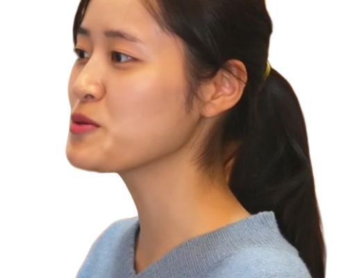 비수술 주걱턱 교정 6개월 후, 결국 수술대 오른 분들의 공통점