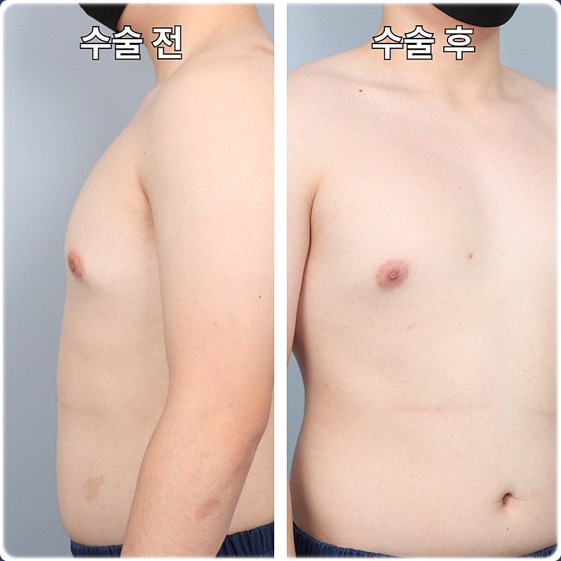 여유증수술비용 등급 판정은 어떻게 진행되나요? [Dr.디에이 여유증]