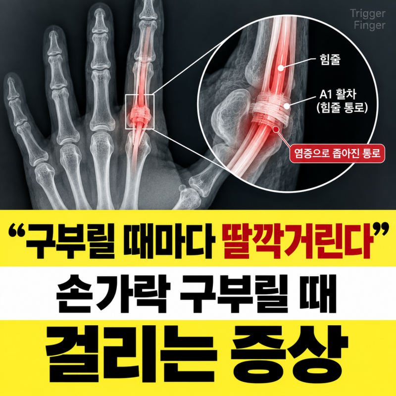손가락 구부릴때 걸리는 느낌 방아쇠수지 증상 치료법