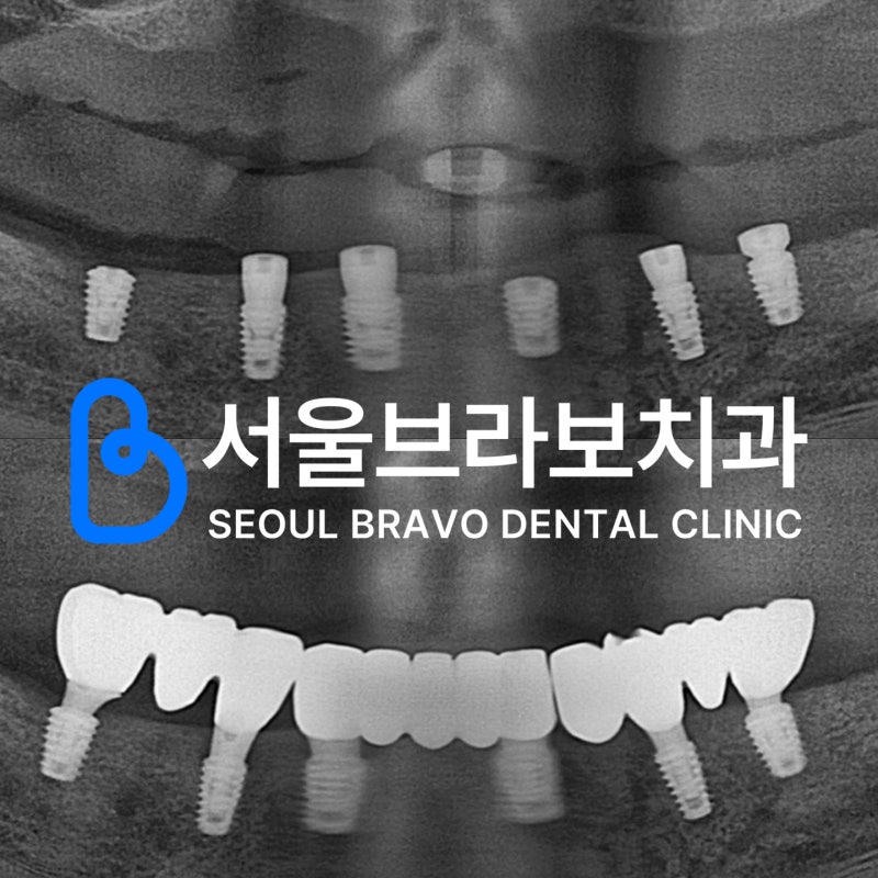 65세 이상 임플란트 건강보험 비용, 2027년 무치악도 적용될까요?