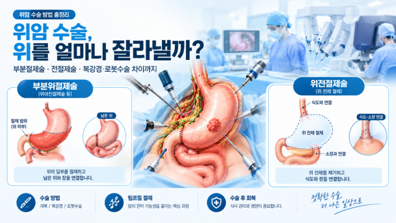 위암5회|위암 수술 방법 총정리｜부분 위 절제술·위전 절제술·복강경·로봇수술 차이