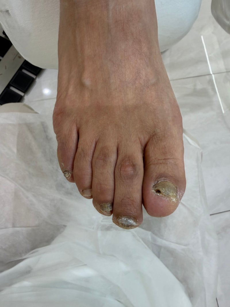 대전 무좀발톱 관리, 두껍고 변색된 발톱 그냥 깎기만 하면 될까요?