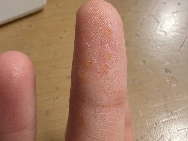 손바닥 수포 반복된다면 이것부터 확인하세요