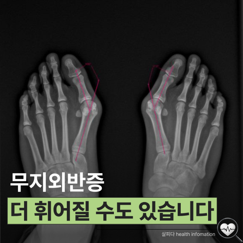 엄지발가락 옆이 "툭" 튀어나왔다면 무지외반증 통증 없다고 그냥 두면 더 심해질 수도