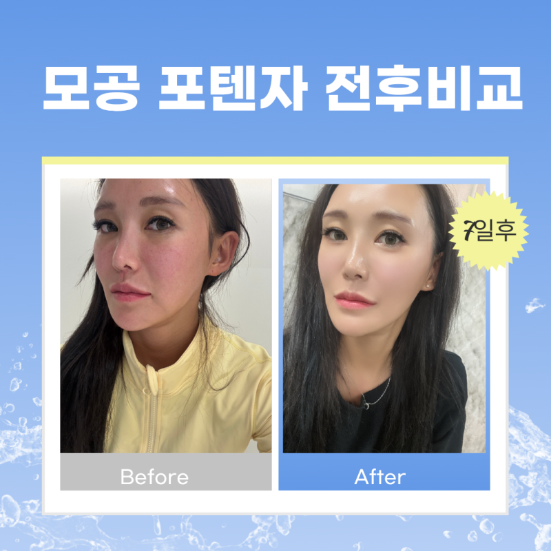 이태원피부과 용산피부과 포텐자 스킨부스터 후기