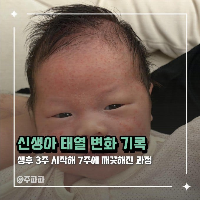 신생아 태열 변화 기록 및 관리법 | 생후 3주 시작해 7주에 깨끗해진 과정