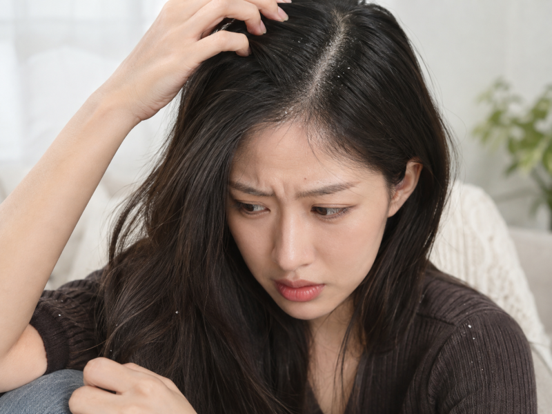비듬 없애는 방법? 지성 비듬과 건성 비듬은 관리가 다릅니다