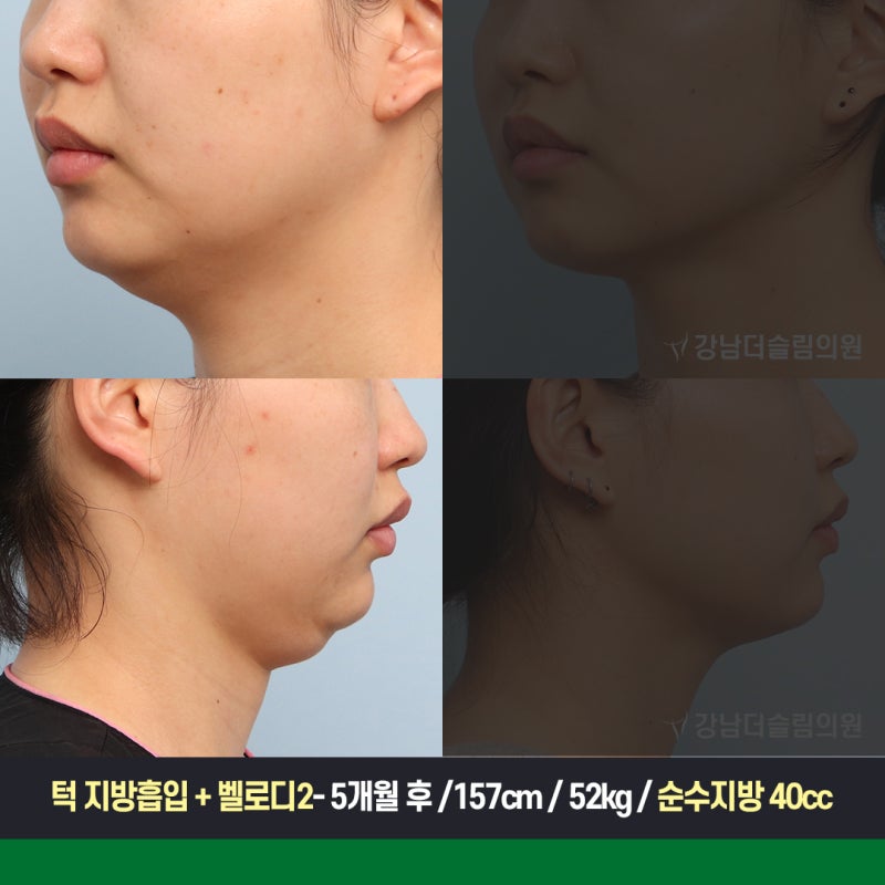 이중턱지방흡입 비용, 윤곽주사를 여러 번 받는 것과 비교하면?