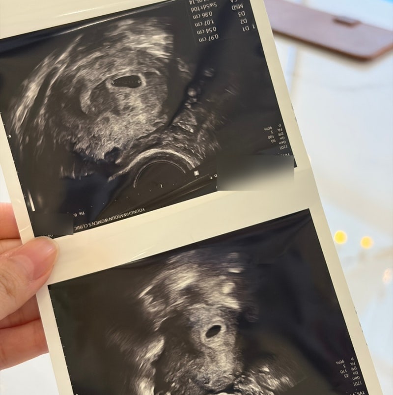 임신극초기증상 1주 2주 3주 4주 총정리ㅣ열 입덧 피비침 복통 허리통증까지