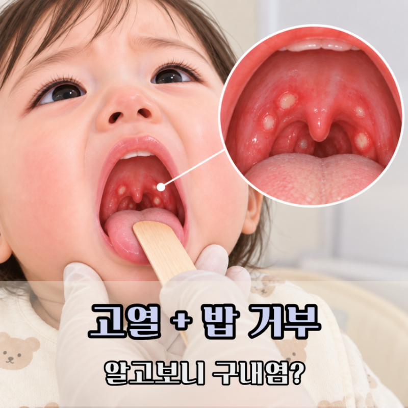 아기 구내염 증상 고열까지?밥 안 먹을 때 먹이기 좋은 음식