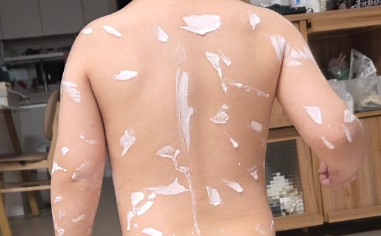 30개월 아기 수두, 며칠 간의 기록 (증상, 격리기간)