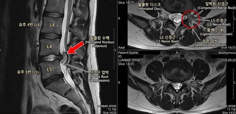 [화성/동탄2 손해사정] 허리디스크 추간판탈출증(M51/S33) 핀 안 박고 수술했어도, 상해후유장....