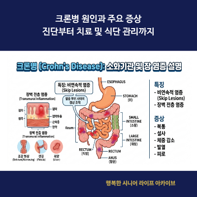 크론병 원인과 주요 증상｜진단부터 치료 및 식단 관리까지