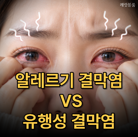"알레르기 결막염 vs 유행성 결막염" 비슷해 보여도 다른 증상 정리