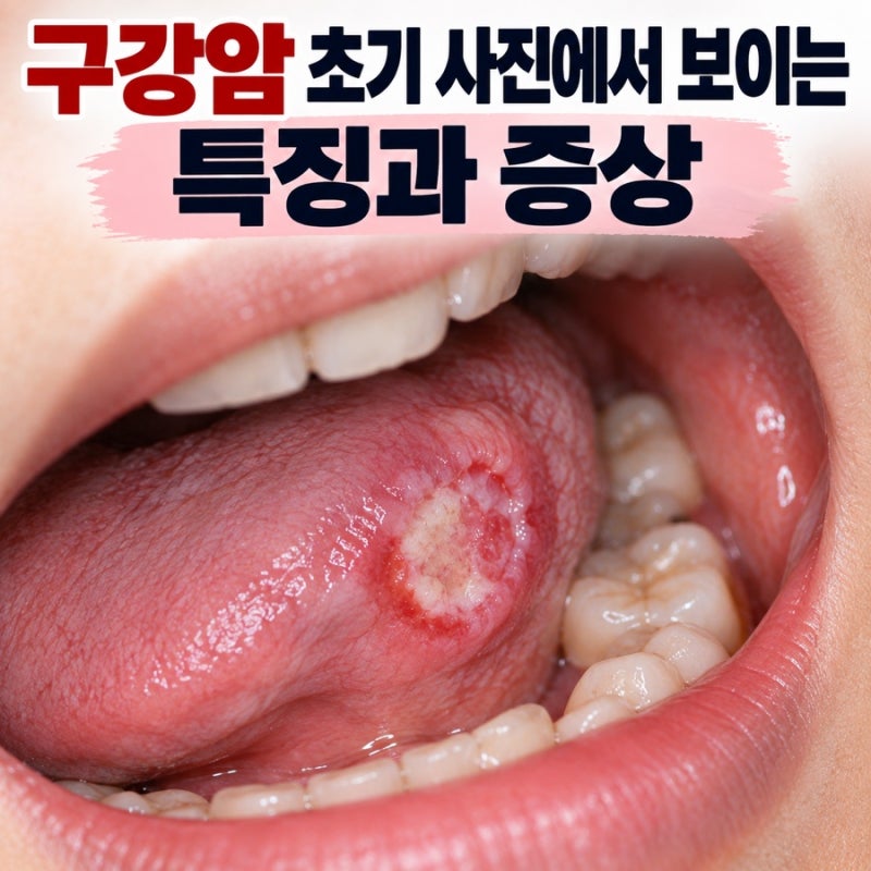 구강암 초기 사진에서 보이는 특징 증상