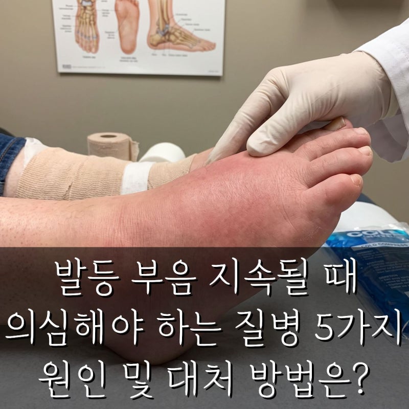 발등 부음 지속될 때 의심해야 하는 질병 5가지 원인 및 대처 방법은?