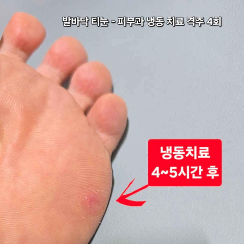 발바닥 티눈 피부과 냉동 치료 통증 후기 격주 4회 : 걷는 보법과 체중분배 근본을 바꾸자 ft. ....