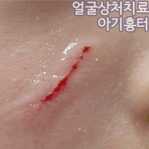 어린이 아기 얼굴 긁힌 상처 치료 방법, 상처 흉터 연고