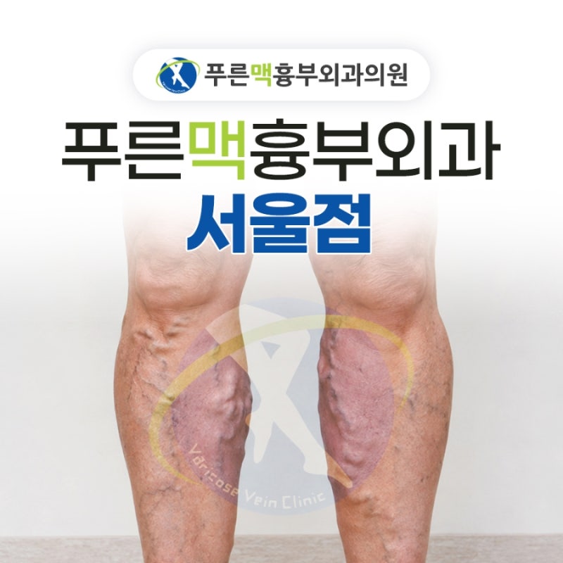 서울 하지 정맥류 병원진단, 초음파검사, 치료 등 선택 기준?
