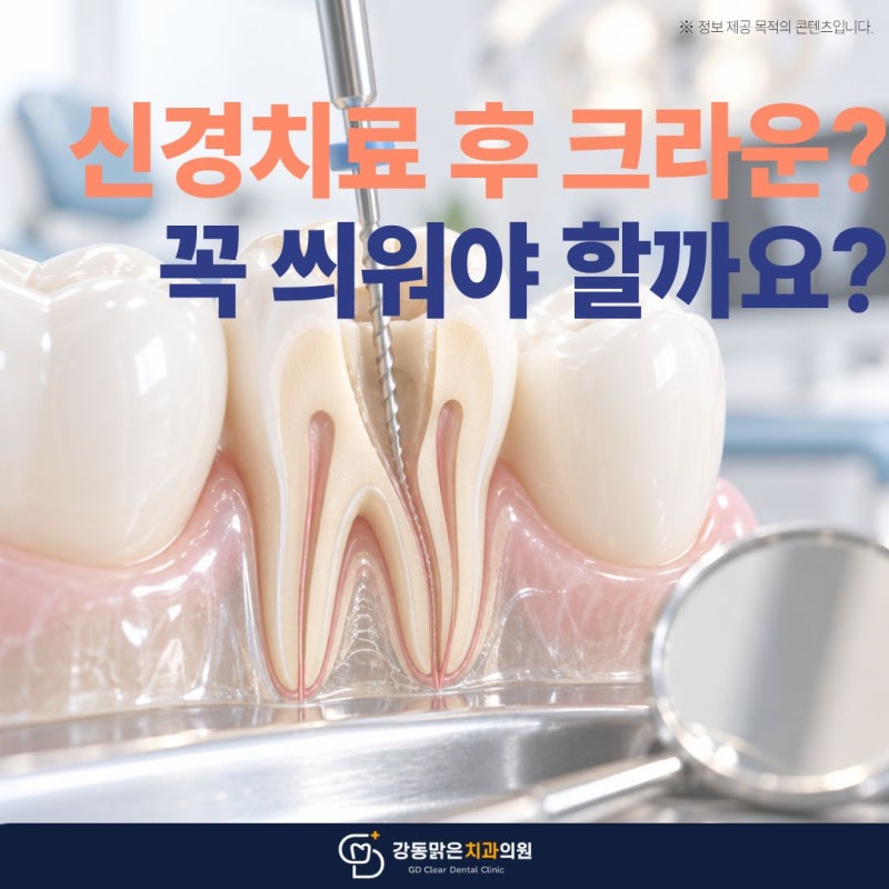 암사동치과｜신경치료 후 크라운, 꼭 씌워야 할까요? 치아마다 다른 이유