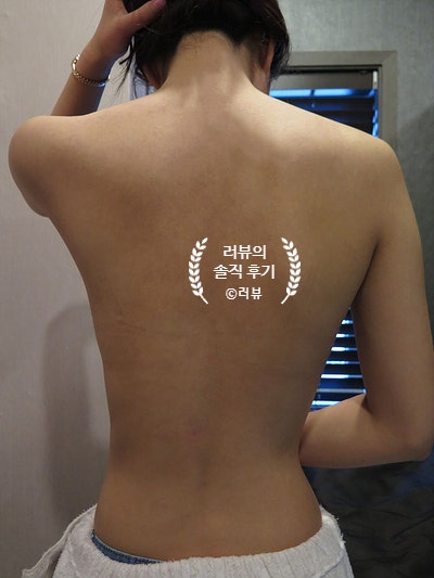 여드름전문피부과에서 해본 등드름 미강약침 치료 기록&결과