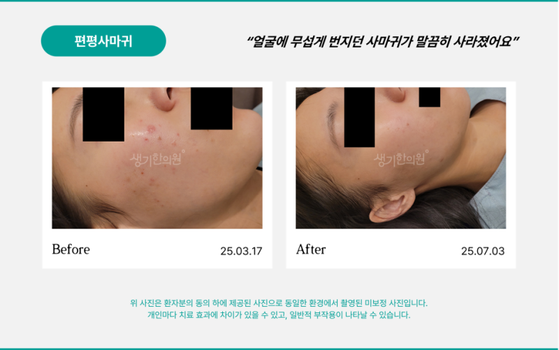편평사마귀 냉동치료 비용 들여 뽑아도 자꾸 번지는 숨은 이유 3가지 완벽 정리