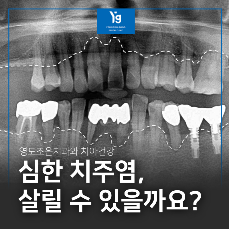 영도치과 만성 치주염, 잇몸뼈 녹았을 때 발치 전 확인할 기준