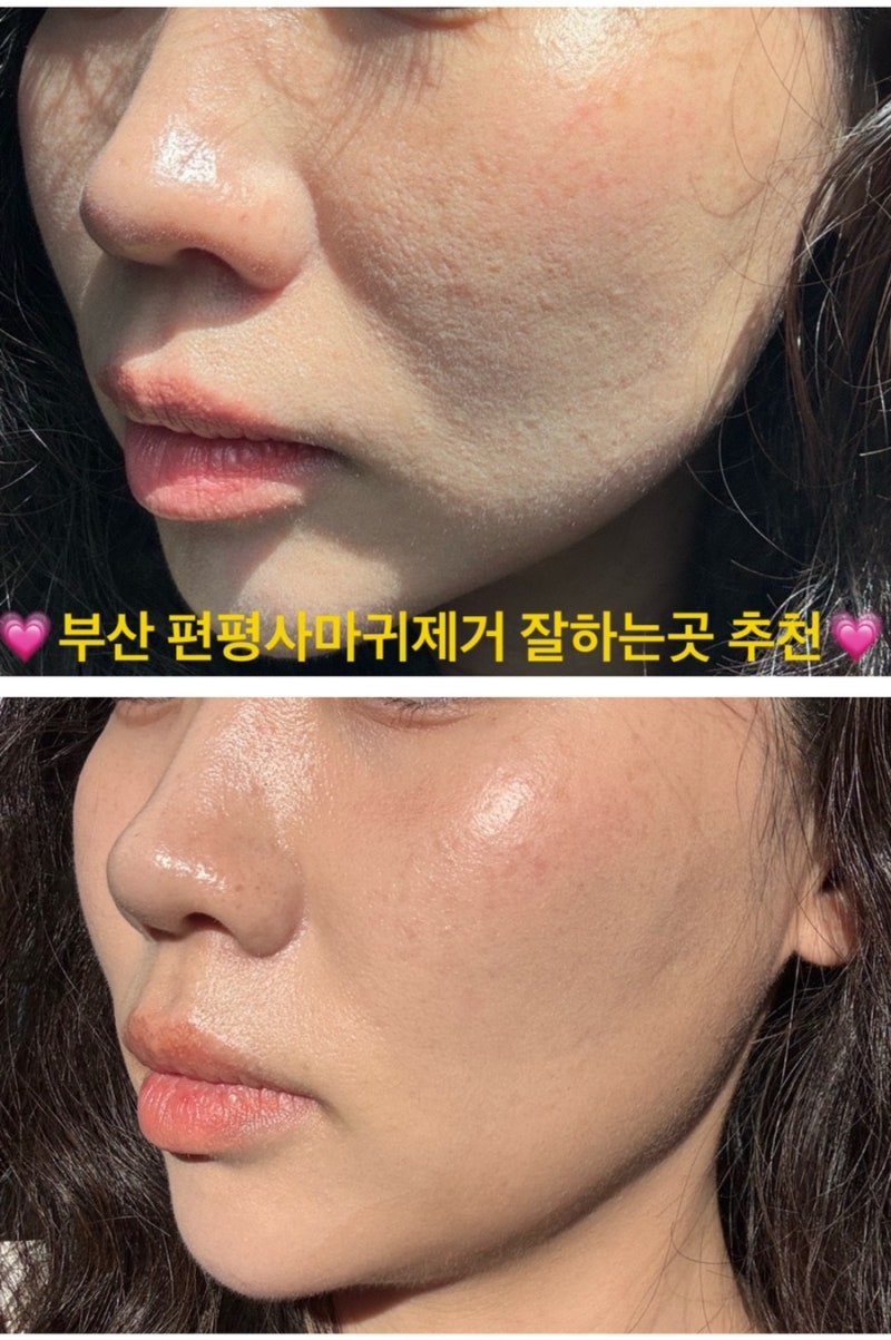 부산 편평사마귀제거 얼굴에서만75개 침으로 제거한 후기