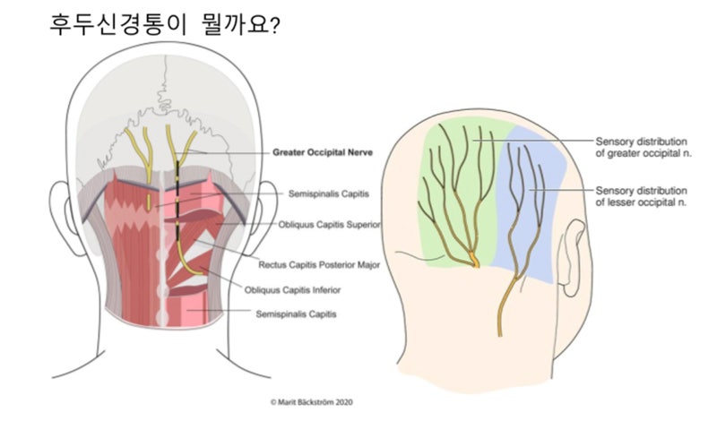 뒷머리가 찌릿하고 아파요, 후두신경통 [목동 화이팅한의원 건강칼럼]