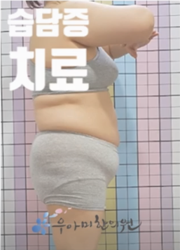 미레나 시술 부작용으로 체중이 늘었다면, 무엇이 달라진 걸까요
