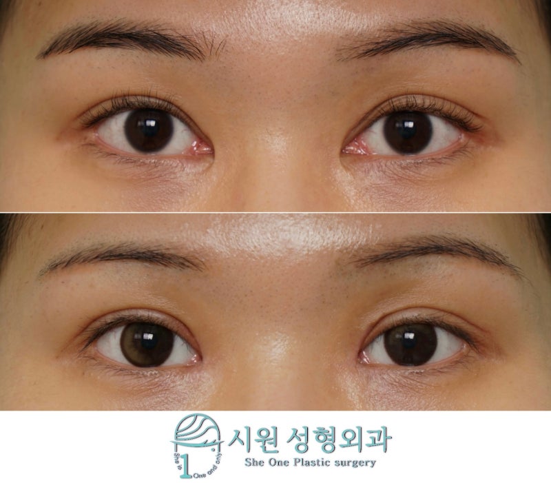 쌍꺼풀 재수술 짝눈, 눈매교정까지 해야 하나요 — 2개월 경과, 638
