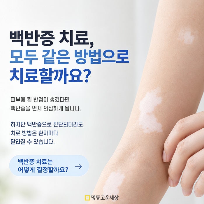 백반증 치료, 정확한 진단과 치료가 중요합니다