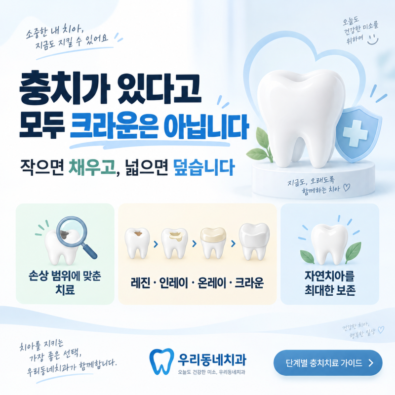 충치가 있으면 무조건 크라운? 레진·인레이·온레이·크라운 단계별 치료 기준