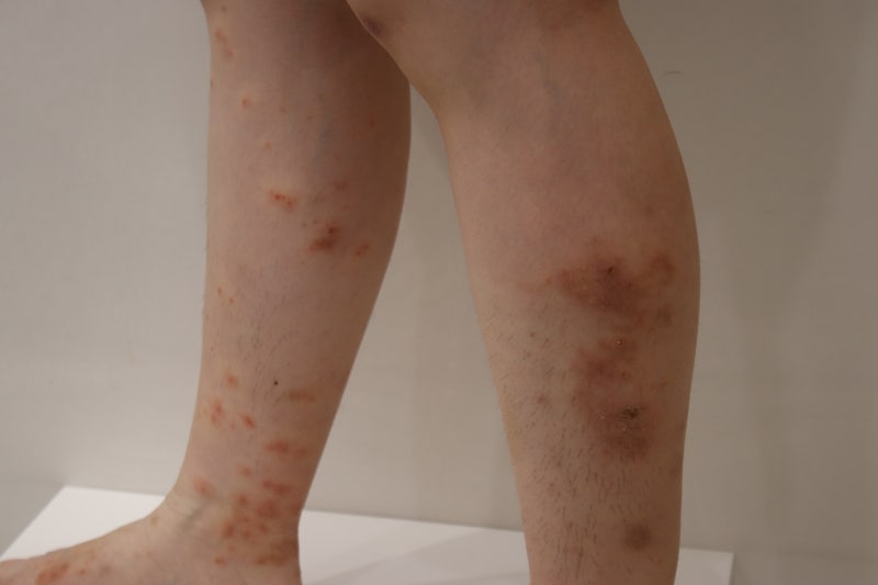 마운자로 두드러기 가려움, 붉은 점들이 생겼다면 이것부터 확인하세요