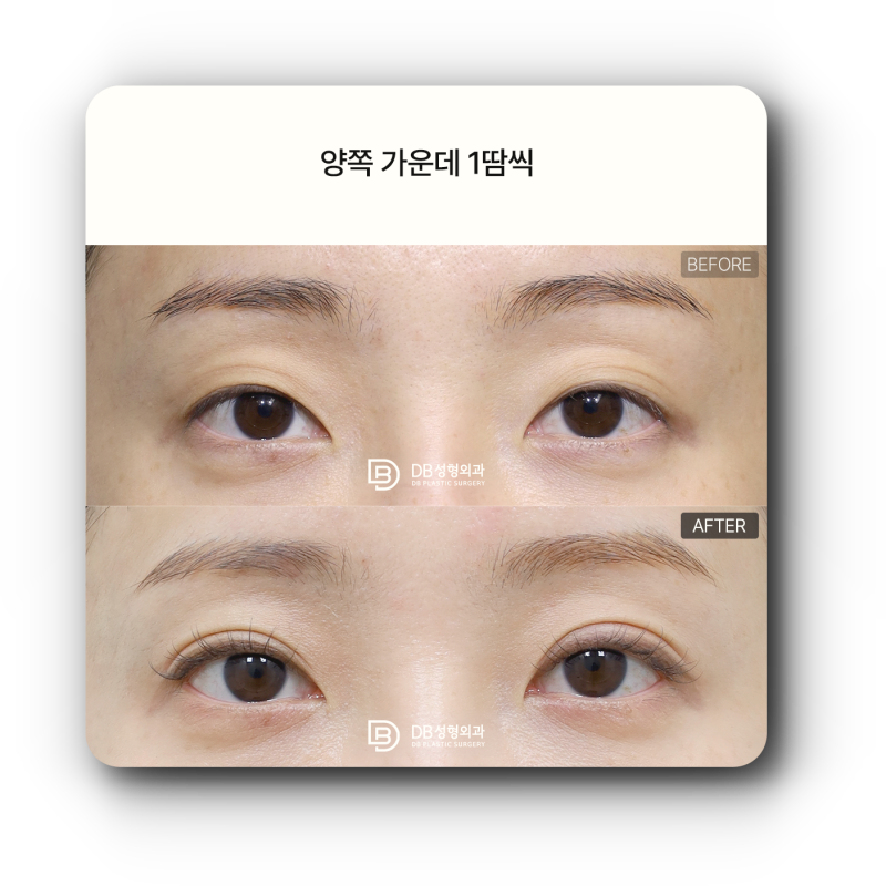 한쪽만 쌍꺼풀 수술해도 될까? 첫수술·재수술 짝눈 수술 방법