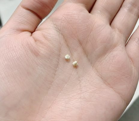 편도결석 제거 흔한 오해 5가지! '사실은 이래요' (냄새, 양치, 재발)