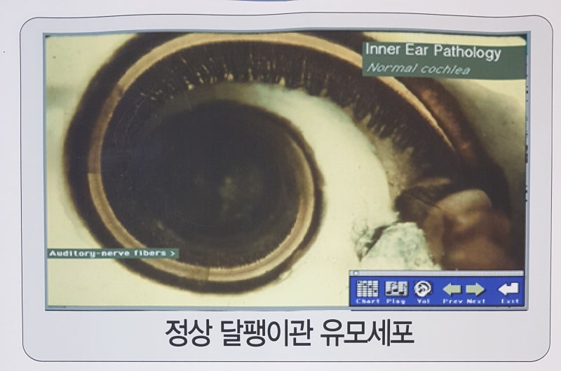 소음성난청 증상, 소음에 오래 노출됐다면 확인해야 할 것