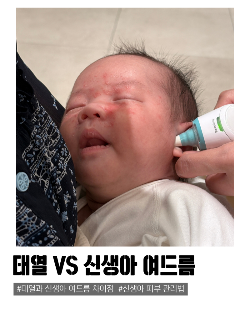 신생아 태열 VS 여드름 구분방법, 남아 생후3주차 태열 피부복구 후기